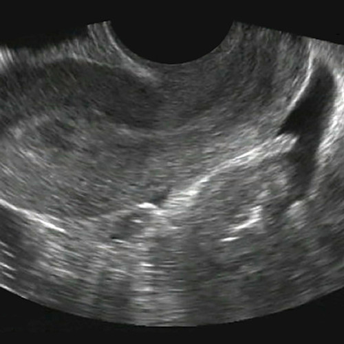 OBGYN Ultrasound Training - SonoSim