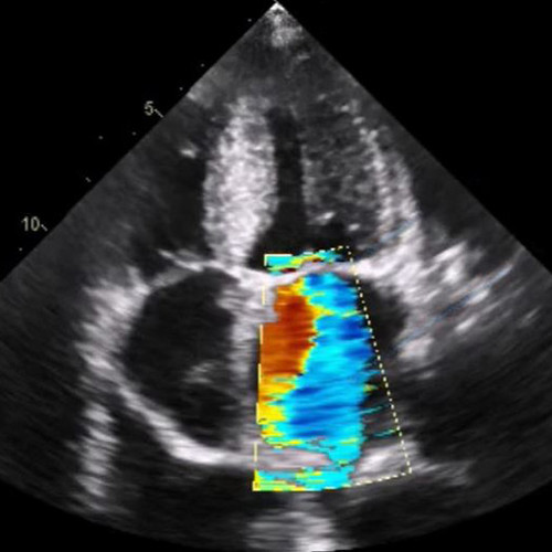 Focused Cardiac Ultrasound Emergency Setting - Focus Ultrasound Exam
