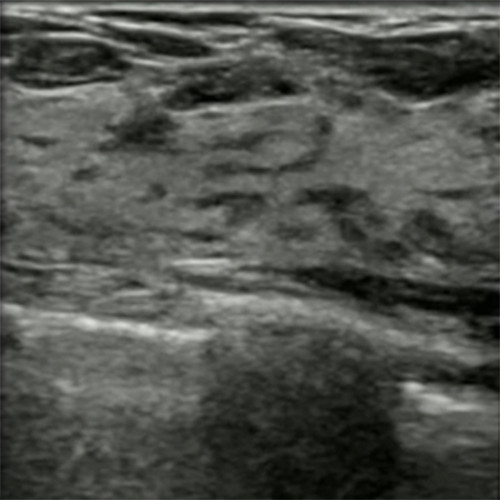 Intro to Breast Ultrasound - SonoSim