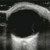 Eye Ultrasound - Ocular Ultrasound Training - SonoSim