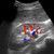 Renal Ultrasound Anatomy Training - SonoSim