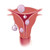 Abnormal GYN - Abnormal Uterus - Ultrasound Training - SonoSim