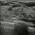 Intro to Breast Ultrasound - SonoSim