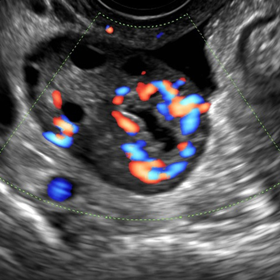 Ultrasound of Pelvic Anatomy Scanning Techniques and 'Normal' Findings  (Chapter 4) - Ultrasound in Reproductive Healthcare Practice