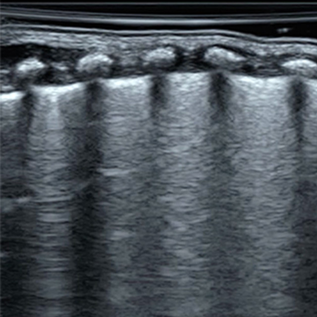 Lungs Ultrasound Training - Pulmonary