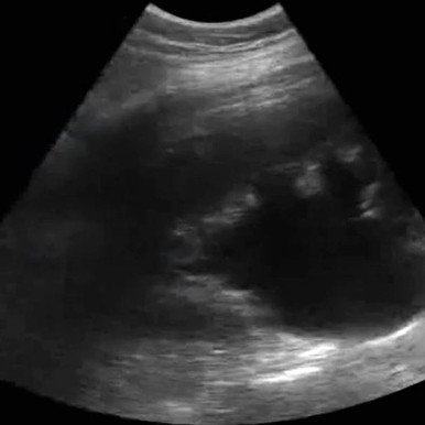 健康・医学 ATLAS OF Renal Ultrasonography O'NEILL clinical_renal_ultrasound__087