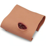 PROJECTILE ENTRY EXIT OF ARM Replacement