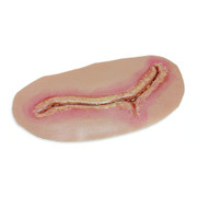 SURGICAL SITE INFECTION LEVEL3 Replacement