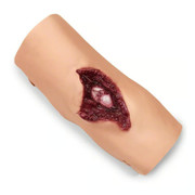 HUMERUS  COMPOUND FRACTURE Replacement