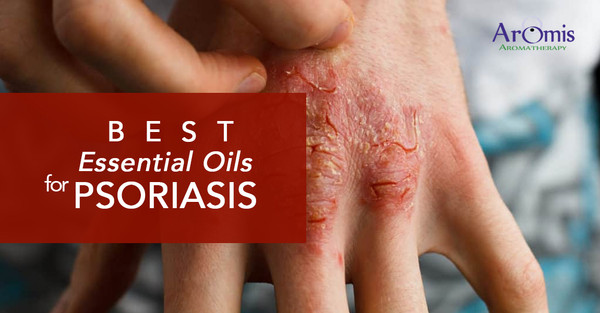 What Can Essential Oils Help You Treat Psoriasis? What’s the Way to Use It?