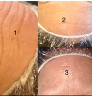 Reveal Your Skin’s  Radiance with Microdermabrasion Treatments.