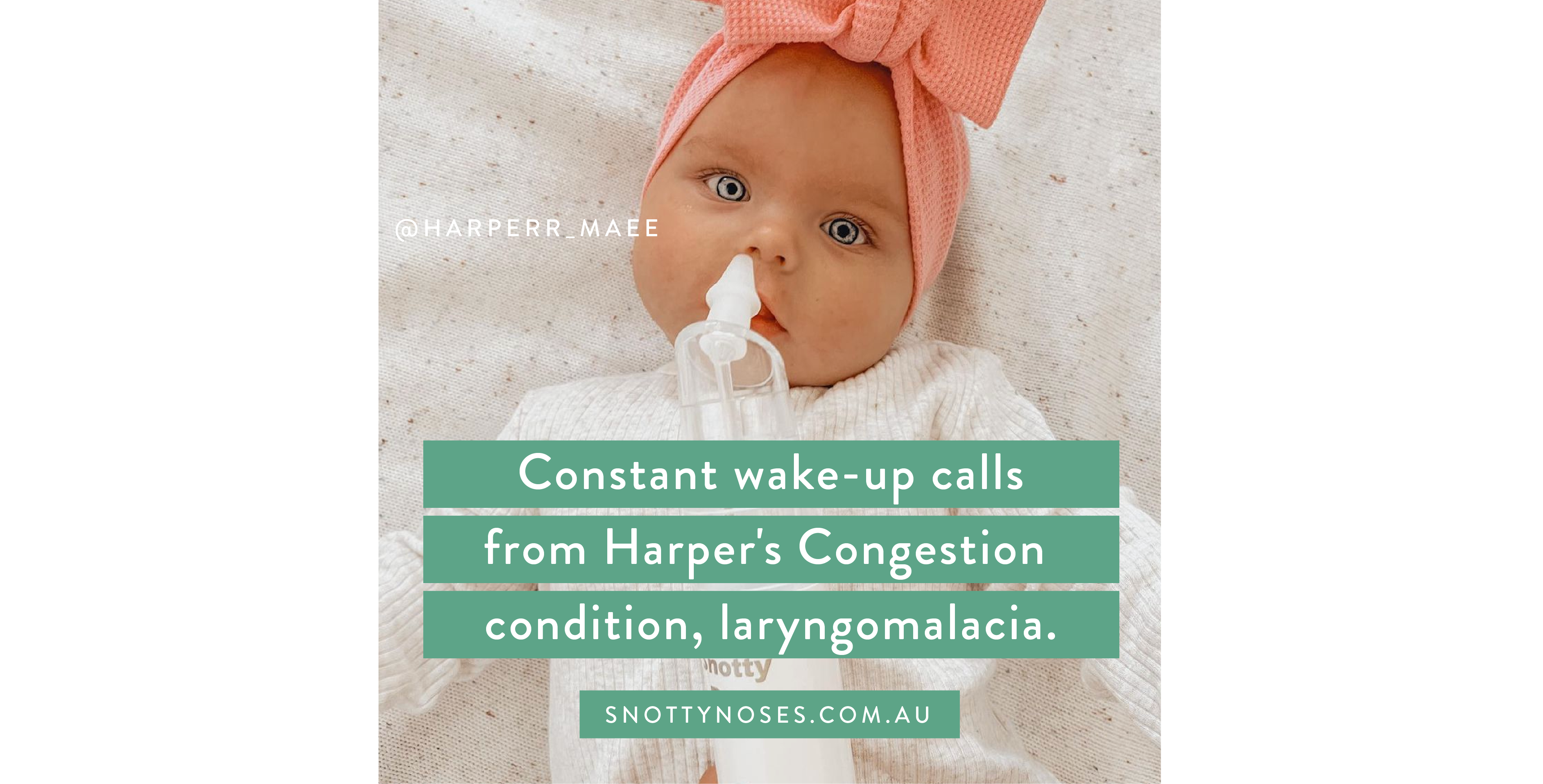 Laryngomalacia Congestion condition and Nasal Aspirators for babies