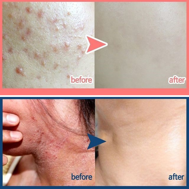 Blemish Clearing Treatment