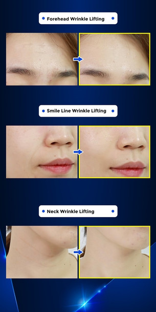 •  Forehead Wrinkle Lifting
•  Smile Line Wrinkle Lifting
•  Neck Wrinkle Lifting