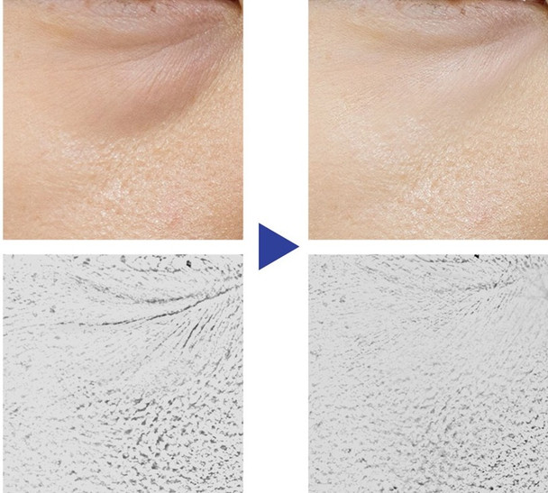 This leads to sagging and deep wrinkles around the eyes.