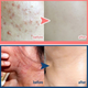 Blemish Clearing Treatment
