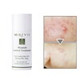 Blemish Control Treatment