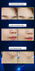 •  Forehead Wrinkle Lifting
•  Smile Line Wrinkle Lifting
•  Neck Wrinkle Lifting