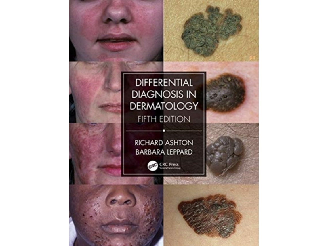 Differential Diagnosis in Dermatology de Richard Ashton y Barbara Leppard (Inglés)