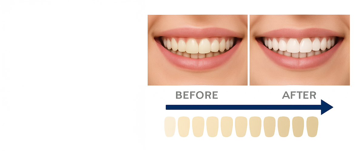 Achieve up to 8 shades whiter teeth in just 45 minutes with Philips Zoom WhiteSpeed.