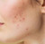 Clear Skin No More Acne Serum 1 oz.