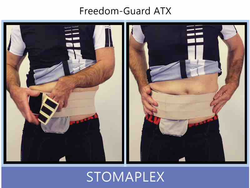 Pull the wide parastomal hernia belt tight to adjust the tension and amout of ostomy support. The support belt applies pressure to the ostomy pouch and skin barrier to extend wear time and to prevent parastomal hernias from developing around the ileostomy.
Bring the wide belt to the front and attach it to the side panel. This will keep the guard securely in place for all types of contact sports. The three tabs will secure the tension of the belt to prevent parastomal hernias. The parastomal ostomy hernia belt is great for those with either a urostomy, colostomy, or ileostomy.
Notice the smooth contour and compressive belt over the ostomy. This stoma guard and belt could take some serious blows to the side without shifting or moving out of place. This is especially important when active with ostomy sports like football, hockey, or roller derby. Ostomy belt, ostomy, stoma, protection, stoma protection, stoma guard, ostomy guard, ostomy protection products, ostomy shower, ostomy leak, stoma leak, ostomy hernia, stoma hernia, ostomy sports, stoma sports, hernia, stoma belt, ostomy leaks, stoma leaks, leaking barrier, leaking stoma, stoma pain, ostomy pain, stomal hernias, hernias, children stoma, pediatric armor, ostomy protection, stoma protection sale, ostomy products, ostomy discounts, ostomy product discounts, ostomy product sale, ostomy ultimate discount package, strong ostomy belt, strongest ostomy belt, stoma shield, stoma shields, stoma guards, stoma protection products, stoma guard belt, stoma protection for sports, stoma protector, stoma guard reviews, stoma protectors, ostomy shower apron, ileostomy, colostomy, stomaplex, ostomy belt swimming, ostomy clothing, ostomy leak protection, freedom guard, comfort guard, veterans ostomy, pediatric ostomy belts, pediatric stoma, pediatric stoma protection, stoma protection for children, children ostomy belts