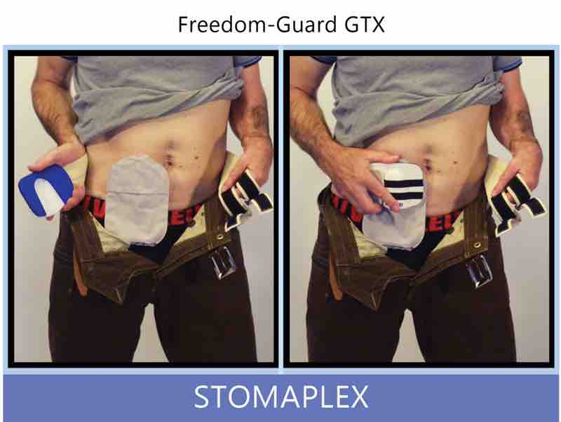 Get ready to position the guard over the stoma. Line of the top-center of the guard to the stoma. The guard covers the top one-third of the ostomy pouch. This allows you to wear your pants and tighten the belt on your pants over the ileostomy, colostomy, or urostomy.
Place the stoma guard over the stoma. In the other hand, continue to hold the ostomy belt. Pull either strap foward to the from of the guard and fasten to the Velcro strip on the face of the guard. The is elastic and will feel nice up next to your skin. Ostomy belt, ostomy, stoma, protection, stoma protection, stoma guard, ostomy guard, ostomy protection products, ostomy shower, ostomy leak, stoma leak, ostomy hernia, stoma hernia, ostomy sports, stoma sports, hernia, stoma belt, ostomy leaks, stoma leaks, leaking barrier, leaking stoma, stoma pain, ostomy pain, stomal hernias, hernias, children stoma, pediatric armor, ostomy protection, stoma protection sale, ostomy products, ostomy discounts, ostomy product discounts, ostomy product sale, ostomy ultimate discount package, strong ostomy belt, strongest ostomy belt, stoma shield, stoma shields, stoma guards, stoma protection products, stoma guard belt, stoma protection for sports, stoma protector, stoma guard reviews, stoma protectors, ostomy shower apron, ileostomy, colostomy, stomaplex, ostomy belt swimming, ostomy clothing, ostomy leak protection, freedom guard, comfort guard, veterans ostomy, pediatric ostomy belts, pediatric stoma, pediatric stoma protection, stoma protection for children, children ostomy belts