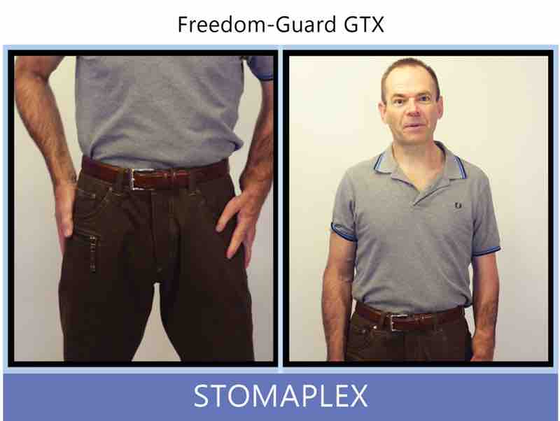 Finish getting dressed with your shirt tucked into your pants with an ostomy. The problem many men face after getting an ostomy is being able to wear normal pants like blue jeans and still be able to tuck their shirt in. This is important if you want to look and dress like you were before ostomy surgery.
Go out an enjoy life! Be confident and stay active. With the stoma guard in place you'll be able to go out to dinner and the movies with any concern that the stoma's output will be restricted by your ostomy clothing. With the Stomaplex ostomy belt and guard, men will find it easier to get dressed in pants. Ostomy belt, ostomy, stoma, protection, stoma protection, stoma guard, ostomy guard, ostomy protection products, ostomy shower, ostomy leak, stoma leak, ostomy hernia, stoma hernia, ostomy sports, stoma sports, hernia, stoma belt, ostomy leaks, stoma leaks, leaking barrier, leaking stoma, stoma pain, ostomy pain, stomal hernias, hernias, children stoma, pediatric armor, ostomy protection, stoma protection sale, ostomy products, ostomy discounts, ostomy product discounts, ostomy product sale, ostomy ultimate discount package, strong ostomy belt, strongest ostomy belt, stoma shield, stoma shields, stoma guards, stoma protection products, stoma guard belt, stoma protection for sports, stoma protector, stoma guard reviews, stoma protectors, ostomy shower apron, ileostomy, colostomy, stomaplex, ostomy belt swimming, ostomy clothing, ostomy leak protection, freedom guard, comfort guard, veterans ostomy, pediatric ostomy belts, pediatric stoma, pediatric stoma protection, stoma protection for children, children ostomy belts