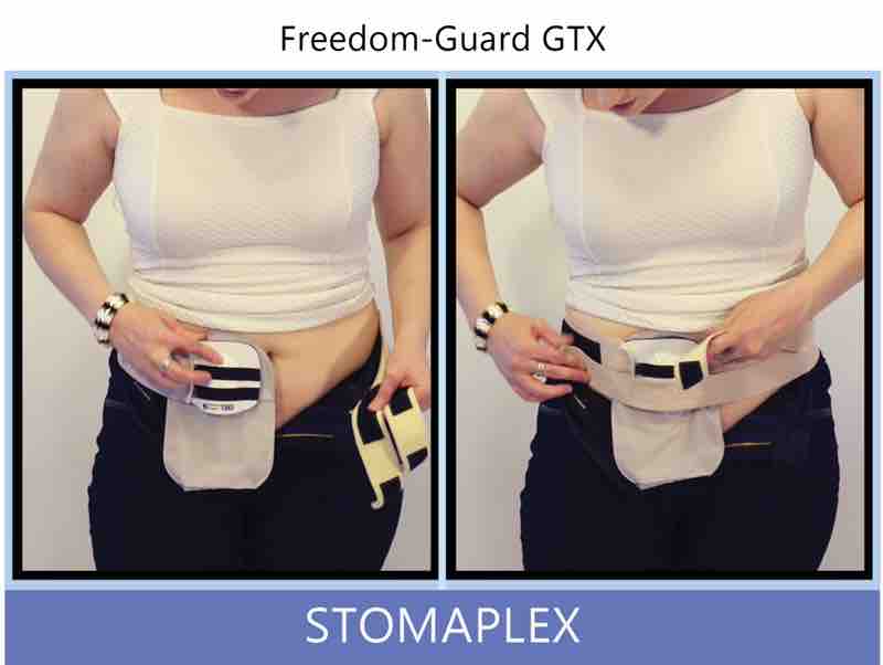 She places the stoma guard on the ostomy bag to cover and protect the stoma. The output from the stoma will flow out the bottom of the guard into the ostomy pouch. She is able to adjust the tilt of the guard by pessing in the top of the guard using her fingers.
Bring the straps of the ostomy belt to the front. Ostomy belt, ostomy, stoma, protection, stoma protection, stoma guard, ostomy guard, ostomy protection products, ostomy shower, ostomy leak, stoma leak, ostomy hernia, stoma hernia, ostomy sports, stoma sports, hernia, stoma belt, ostomy leaks, stoma leaks, leaking barrier, leaking stoma, stoma pain, ostomy pain, stomal hernias, hernias, children stoma, pediatric armor, ostomy protection, stoma protection sale, ostomy products, ostomy discounts, ostomy product discounts, ostomy product sale, ostomy ultimate discount package, strong ostomy belt, strongest ostomy belt, stoma shield, stoma shields, stoma guards, stoma protection products, stoma guard belt, stoma protection for sports, stoma protector, stoma guard reviews, stoma protectors, ostomy shower apron, ileostomy, colostomy, stomaplex, ostomy belt swimming, ostomy clothing, ostomy leak protection, freedom guard, comfort guard, veterans ostomy, pediatric ostomy belts, pediatric stoma, pediatric stoma protection, stoma protection for children, children ostomy belts
