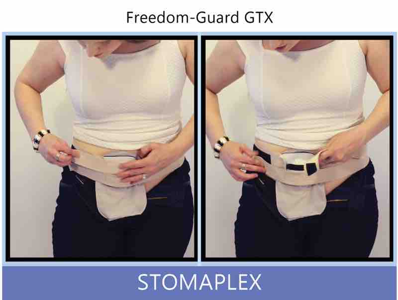 Notice the nice smooth profile and contour the guard and belt makes with her body. The smooth appearance will look nice under her ostomy clothing and she will be able to tighten her pants or jeans right up over the top of the stoma. This is important for any women with an ostomy if the waistband of her pants would restrict the output.
Hold your ostomy bag down while you pull up and button the top button of your jeans. Keep the ostomy bag from getting buched up. Keep the volume of the ostomy pouch as full as possible by keeping it flat under your ostomy clothing. Ostomy belt, ostomy, stoma, protection, stoma protection, stoma guard, ostomy guard, ostomy protection products, ostomy shower, ostomy leak, stoma leak, ostomy hernia, stoma hernia, ostomy sports, stoma sports, hernia, stoma belt, ostomy leaks, stoma leaks, leaking barrier, leaking stoma, stoma pain, ostomy pain, stomal hernias, hernias, children stoma, pediatric armor, ostomy protection, stoma protection sale, ostomy products, ostomy discounts, ostomy product discounts, ostomy product sale, ostomy ultimate discount package, strong ostomy belt, strongest ostomy belt, stoma shield, stoma shields, stoma guards, stoma protection products, stoma guard belt, stoma protection for sports, stoma protector, stoma guard reviews, stoma protectors, ostomy shower apron, ileostomy, colostomy, stomaplex, ostomy belt swimming, ostomy clothing, ostomy leak protection, freedom guard, comfort guard, veterans ostomy, pediatric ostomy belts, pediatric stoma, pediatric stoma protection, stoma protection for children, children ostomy belts