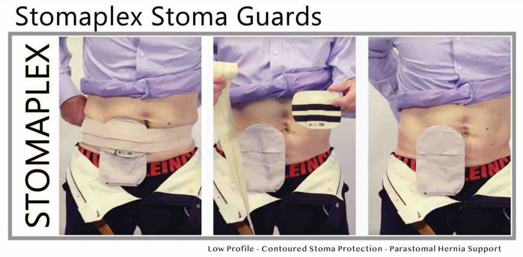 Stoma Guard The Customizable Stoma Guard Stomaplex