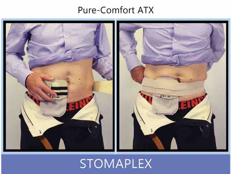 Place the stoma guard over the stoma. Make sure that the guard is comfortable. Bring the Stomaplex ostomy belt around and to the front of your body. You will notice how soft and comfortable the ostomy belt is next to your skin.
Finish attaching the ostomy belts two straps. Is the ostomy belt snug? A snug or tight belt will help keep the stoma guard in position. You may have to adjust the tension of the belt by running your fingers around the side. Ostomy belt, ostomy, stoma, protection, stoma protection, stoma guard, ostomy guard, ostomy protection products, ostomy shower, ostomy leak, stoma leak, ostomy hernia, stoma hernia, ostomy sports, stoma sports, hernia, stoma belt, ostomy leaks, stoma leaks, leaking barrier, leaking stoma, stoma pain, ostomy pain, stomal hernias, hernias, children stoma, pediatric armor, ostomy protection, stoma protection sale, ostomy products, ostomy discounts, ostomy product discounts, ostomy product sale, ostomy ultimate discount package, strong ostomy belt, strongest ostomy belt, stoma shield, stoma shields, stoma guards, stoma protection products, stoma guard belt, stoma protection for sports, stoma protector, stoma guard reviews, stoma protectors, ostomy shower apron, ileostomy, colostomy, stomaplex, ostomy belt swimming, ostomy clothing, ostomy leak protection, freedom guard, comfort guard, veterans ostomy, pediatric ostomy belts, pediatric stoma, pediatric stoma protection, stoma protection for children, children ostomy belts