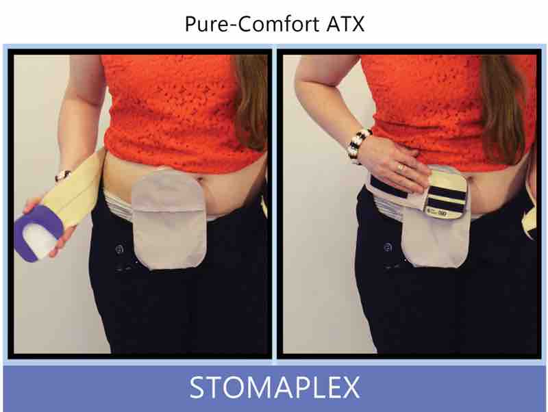 Wrap the belt around your back holding the stoma guard in your hand. Notice, the stoma guard is already attached to the belt. In the other hand, hold the opposite end of the ostomy belt. Look ar wear the center of the stoma is and begin to place the stoma guard over the ostomy bag.
Bring the belt to the from and attach it to the velcro strips on the stoma guard and to the landing pad on the side. The tension on top and the bottom of the guard can be adjusted independently. The guard should sit over the stoma and not be too close.
Pure-Comfort ATX: Place the stoma guard over the ostomy. If you press on the top, you'll see the bottom of the guard tilt out allowing for greater flow from the ostomy. Ostomy belt, ostomy, stoma, protection, stoma protection, stoma guard, ostomy guard, ostomy protection products, ostomy shower, ostomy leak, stoma leak, ostomy hernia, stoma hernia, ostomy sports, stoma sports, hernia, stoma belt, ostomy leaks, stoma leaks, leaking barrier, leaking stoma, stoma pain, ostomy pain, stomal hernias, hernias, children stoma, pediatric armor, ostomy protection, stoma protection sale, ostomy products, ostomy discounts, ostomy product discounts, ostomy product sale, ostomy ultimate discount package, strong ostomy belt, strongest ostomy belt, stoma shield, stoma shields, stoma guards, stoma protection products, stoma guard belt, stoma protection for sports, stoma protector, stoma guard reviews, stoma protectors, ostomy shower apron, ileostomy, colostomy, stomaplex, ostomy belt swimming, ostomy clothing, ostomy leak protection, freedom guard, comfort guard, veterans ostomy, pediatric ostomy belts, pediatric stoma, pediatric stoma protection, stoma protection for children, children ostomy belts