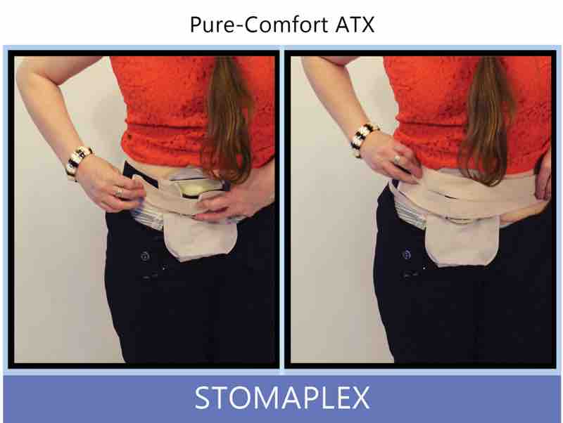 Attach the second strap of the belt to the guard and again to itself. Feel the support that this belt give your abdomen around the site of the ostomy. Adjust the tension of the belt. The belt will feel a little sug and that is good because it be providing some parastomal hernia support.
With the stoma guard centered over the stoma and the ostomy belt tension made comfortable, you'll be ready to go to work in the office with nice dress clothes like dresses, skirts, and pants. After the stoma guard and belt is under your clothing, your be confident to go about an active life. Ostomy belt, ostomy, stoma, protection, stoma protection, stoma guard, ostomy guard, ostomy protection products, ostomy shower, ostomy leak, stoma leak, ostomy hernia, stoma hernia, ostomy sports, stoma sports, hernia, stoma belt, ostomy leaks, stoma leaks, leaking barrier, leaking stoma, stoma pain, ostomy pain, stomal hernias, hernias, children stoma, pediatric armor, ostomy protection, stoma protection sale, ostomy products, ostomy discounts, ostomy product discounts, ostomy product sale, ostomy ultimate discount package, strong ostomy belt, strongest ostomy belt, stoma shield, stoma shields, stoma guards, stoma protection products, stoma guard belt, stoma protection for sports, stoma protector, stoma guard reviews, stoma protectors, ostomy shower apron, ileostomy, colostomy, stomaplex, ostomy belt swimming, ostomy clothing, ostomy leak protection, freedom guard, comfort guard, veterans ostomy, pediatric ostomy belts, pediatric stoma, pediatric stoma protection, stoma protection for children, children ostomy belts