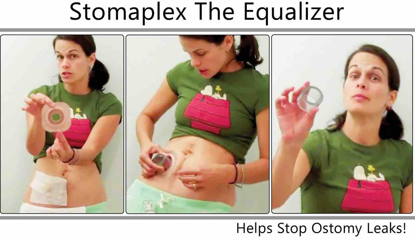 Stoma Guard Peace Of Mind Ostomy Belt by Stomaplex