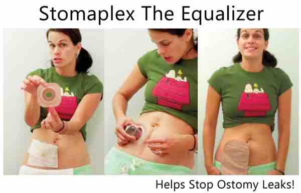 Stoma Guard Ostomy Belt Stomaplex 