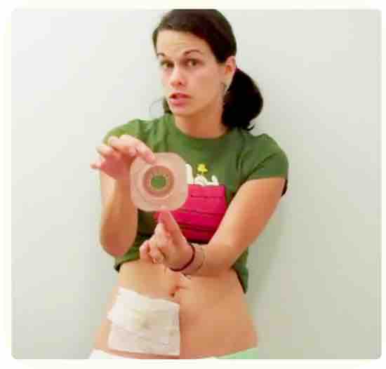 Prepare the ostomy skin barrier and your skin to make a new clean and easy ostomy bag change. Prepare the ostomy skin barrier and your skin to make a new clean and easy ostomy bag change.