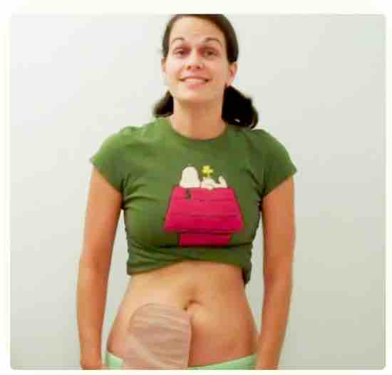 Now that the ostomy appliance is secured in place. You are good to go! Enjoy your day and be confident that your ostomy will not leak. Now that the ostomy appliance is secured in place. You are good to go! Enjoy your day and be confident that your ostomy will not leak.