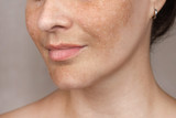 Woman with dark and age spots.