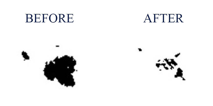 Before and After results of Melanin in the skin.