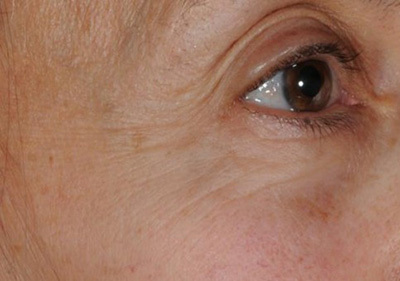 Before image of an eye contour without treatment with Marine Samphire
