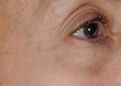 After image of an eye contour with marine samphire treatment