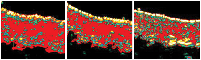 Treatment measured starting at before, after 4 weeks, and ending after 8 weeks. Collagen density increases as time goes on.