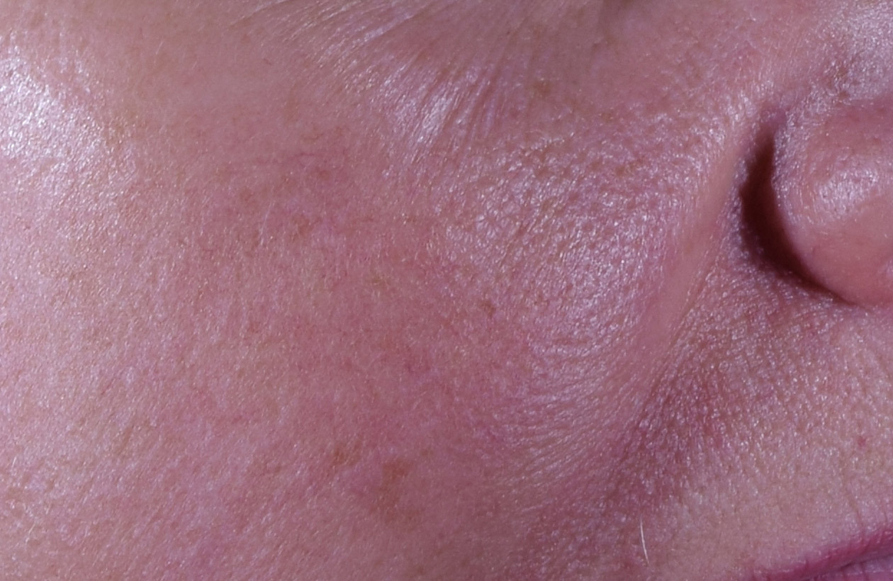 Before using perles des mers, this persons skin had dull tired skin.