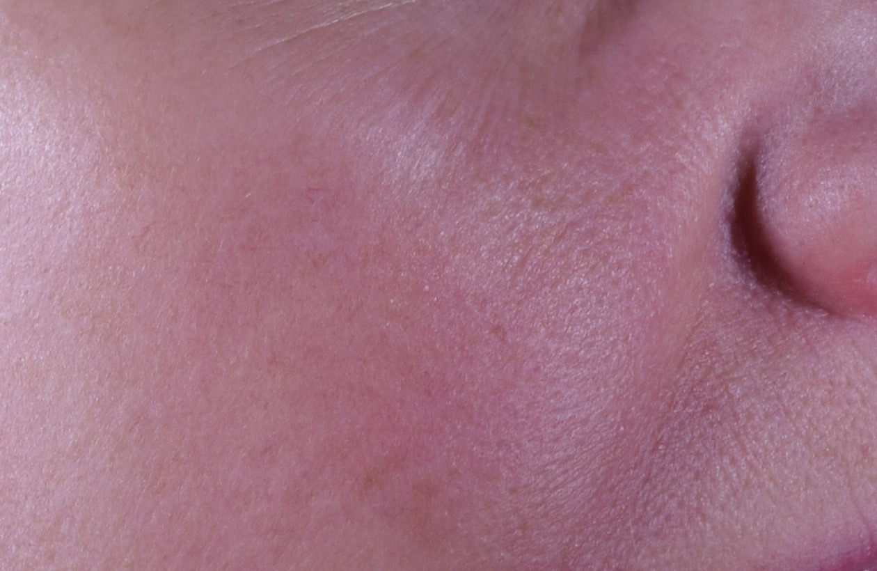 Before using perles des mers, this persons skin had smoother, more radiant, and healthy looking skin.