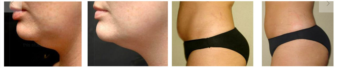 lipo-4-pics-before-and-after.png