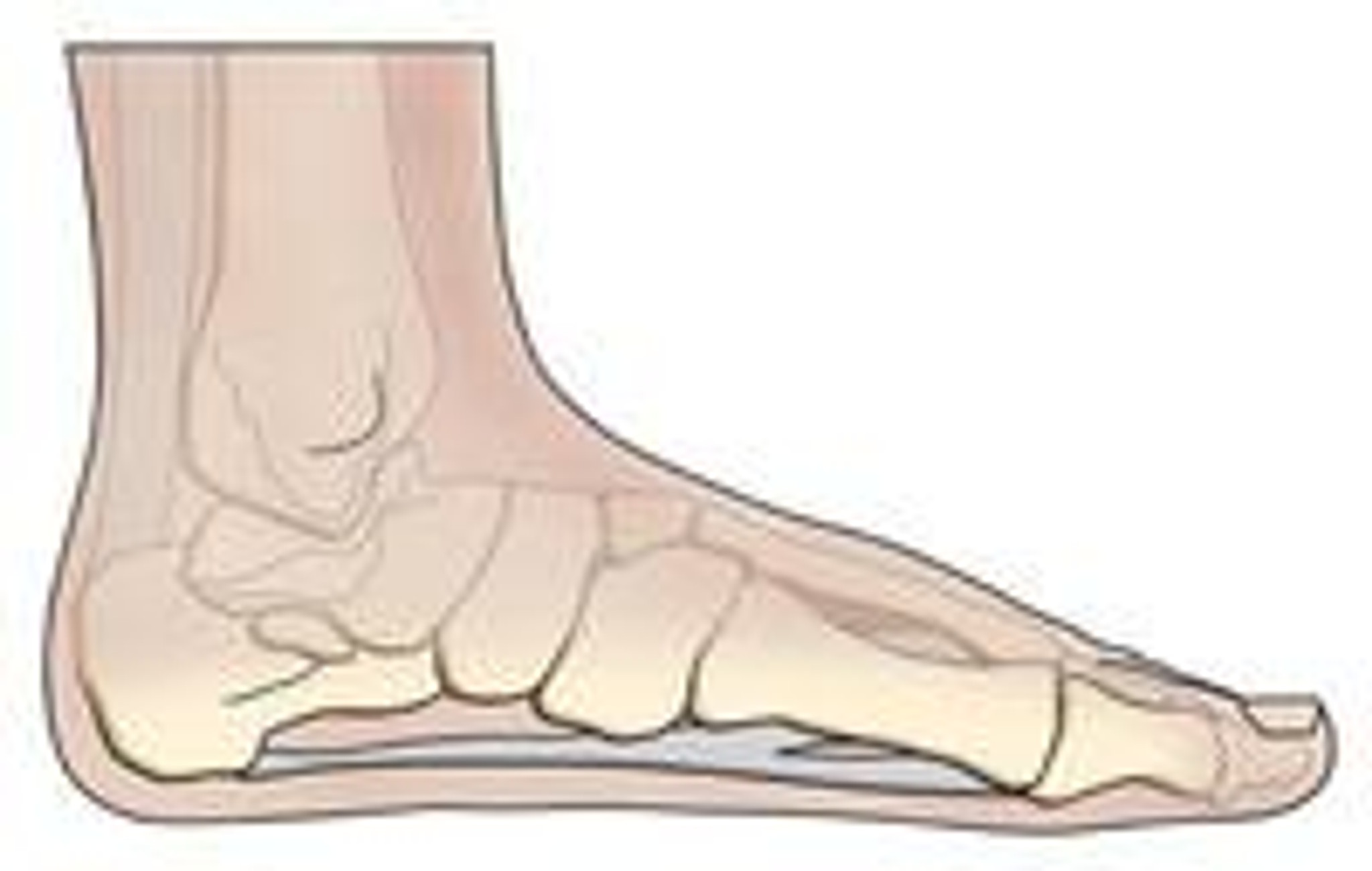 Platvoeten of fasciitis plantaris