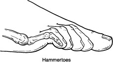 hammertoe.jpg