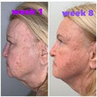 Before and After ZAQ 7 in 1 Facial Rejuvenation LED Device