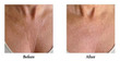 Before and after Dreambox Plump Chest Treatment Pad Model 1
